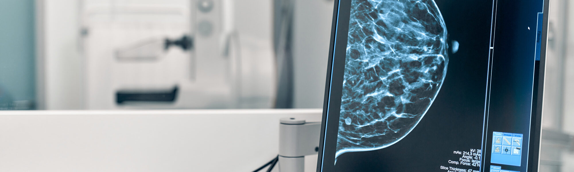 Breast density imaging on a screen