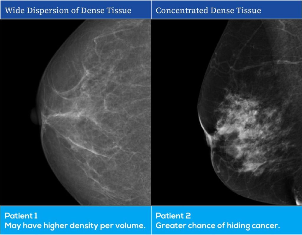 breast density examples