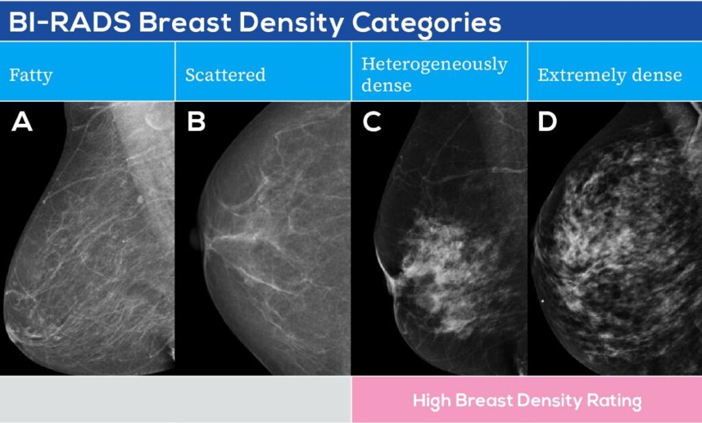 breast density categories