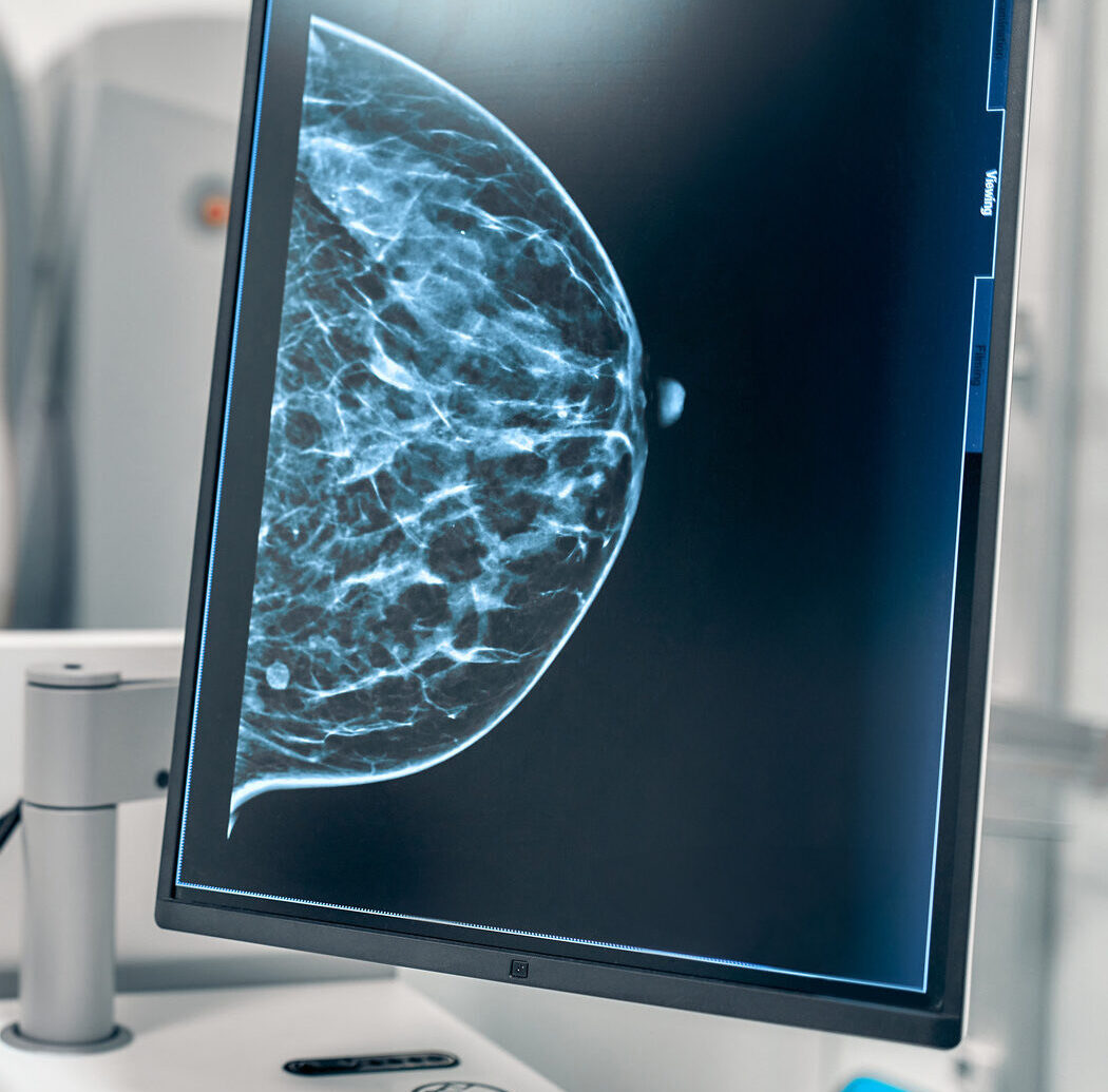 Breast density imaging on a screen