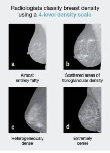 breast density scale portrait comparisons