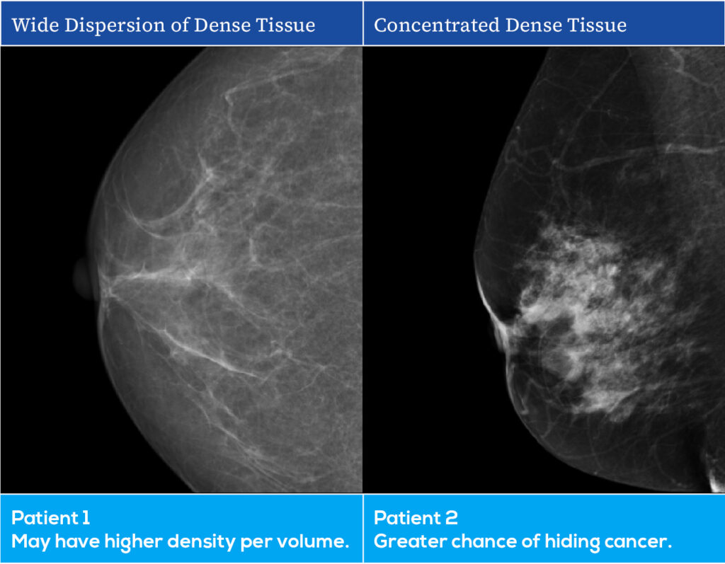 Breast density imaging examples